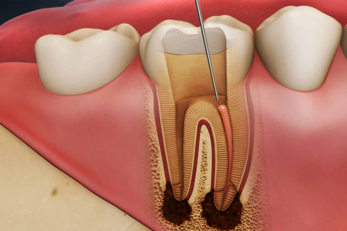 هزینه عصب کشی و درمان ریشه (Root Canal) در ایران